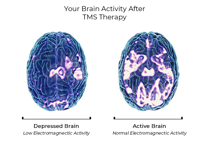 Your brain activity before and after TMS therapy